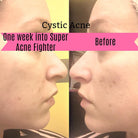 Super Acne Fighter / Organic Acne Treatment / Acne - Life's Fun Treasures