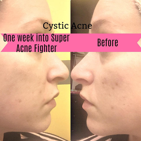 Super Acne Fighter / Organic Acne Treatment / Acne - Life's Fun Treasures