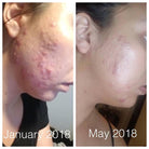 Super Acne Fighter / Organic Acne Treatment / Acne - Life's Fun Treasures