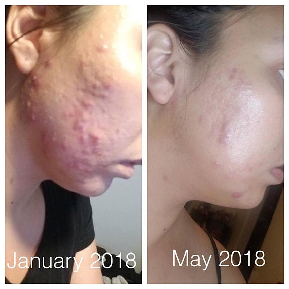 Super Acne Fighter / Organic Acne Treatment / Acne - Life's Fun Treasures